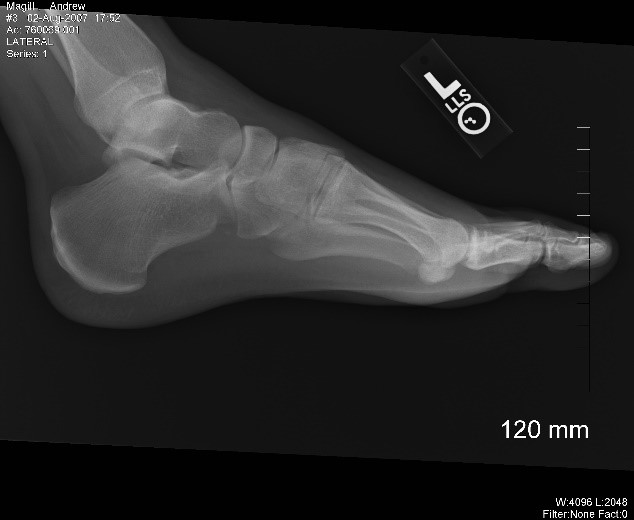 (Left) X-ray image of a normal foot, (right): X-ray image of a bound foot.